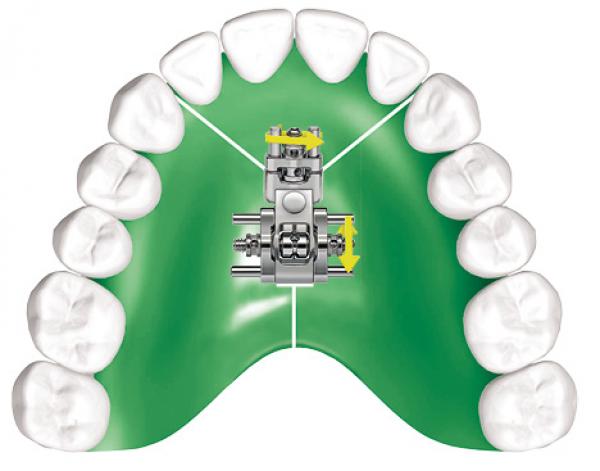 BERTONI 2.0 Mehrsektorenschraube